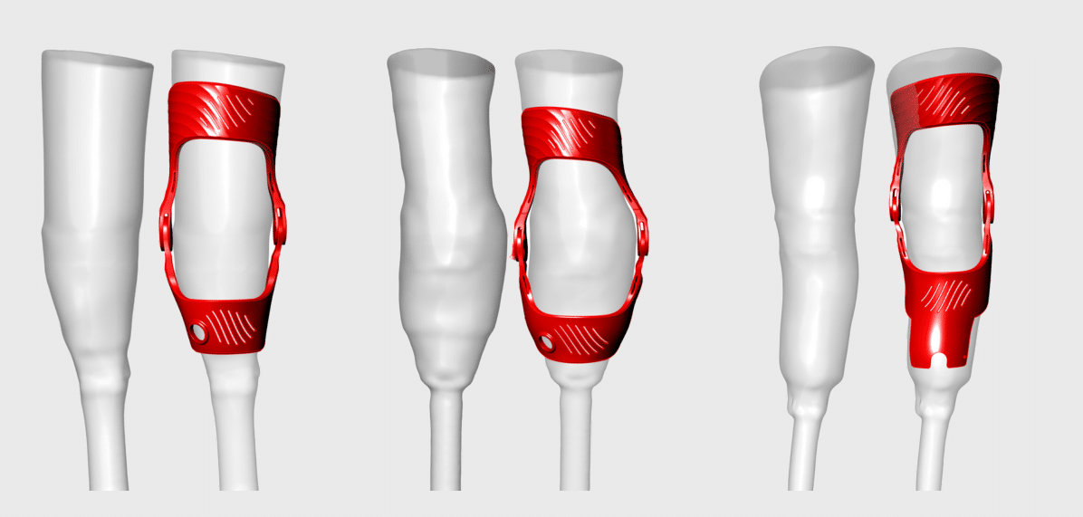 brace variation